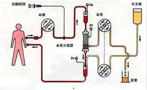 国产血浆置换操作流程视频,视频教程助您掌握关键步骤